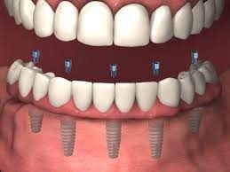 alabama periodontics	https://www.alabamaperiodontics.com/