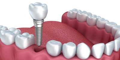 At Alabama Periodontics, we specialize in dental implant placement, cosmetic gum contouring, treatment of periodontal disease, receding gums, the diagnosis and treatment of oral pathologies, and preventative cleanings. We utilize the latest technology, including dynamic 3D navigation and laser-assisted surgeries to maximize the quickest healing times and best results for our patients. https://www.alabamaperiodontics.com/